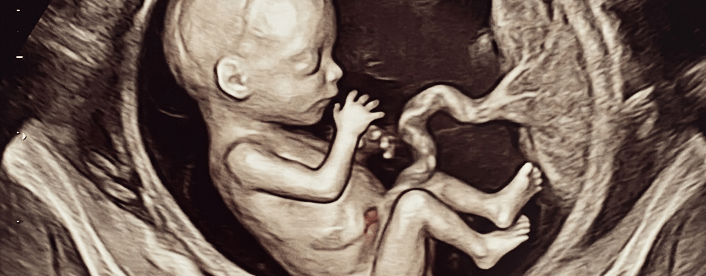 3D ultrasound image of a 28-week fetus curled inside the amniotic sac with visible umbilical cord