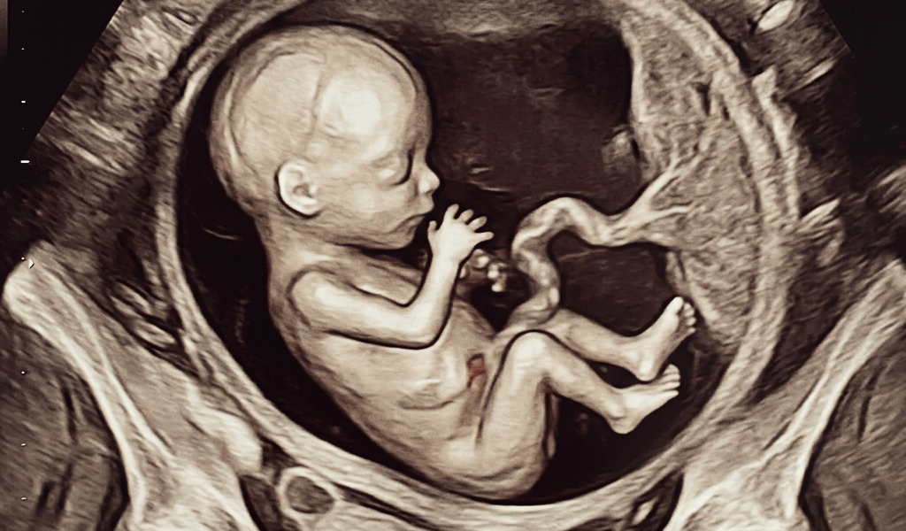 3D ultrasound image of a 28-week fetus curled inside the amniotic sac with visible umbilical cord